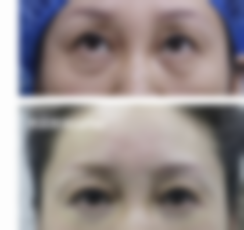 如何使脸部老疤痕修复：面子工程大作战