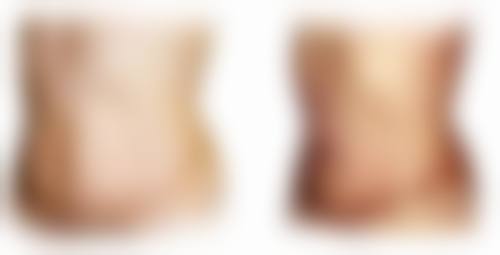 脸上凹陷疤痕涂抹祛疤膏之祛疤膏的正确打开方式