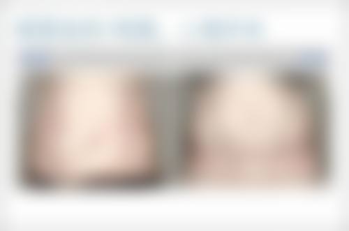 隆鼻术后一般需要多少天修复——一场耐心的马拉松之旅