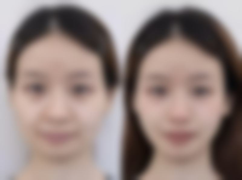 脸上凹陷疤痕涂抹祛疤膏之匠益生医用硅凝胶——性价比之王的魅力