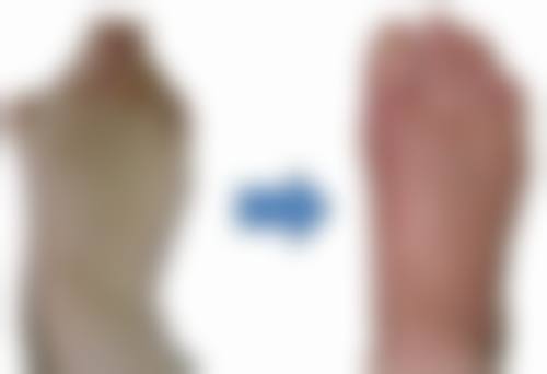 开水烫伤疤痕如何消除之日常护理注意要点