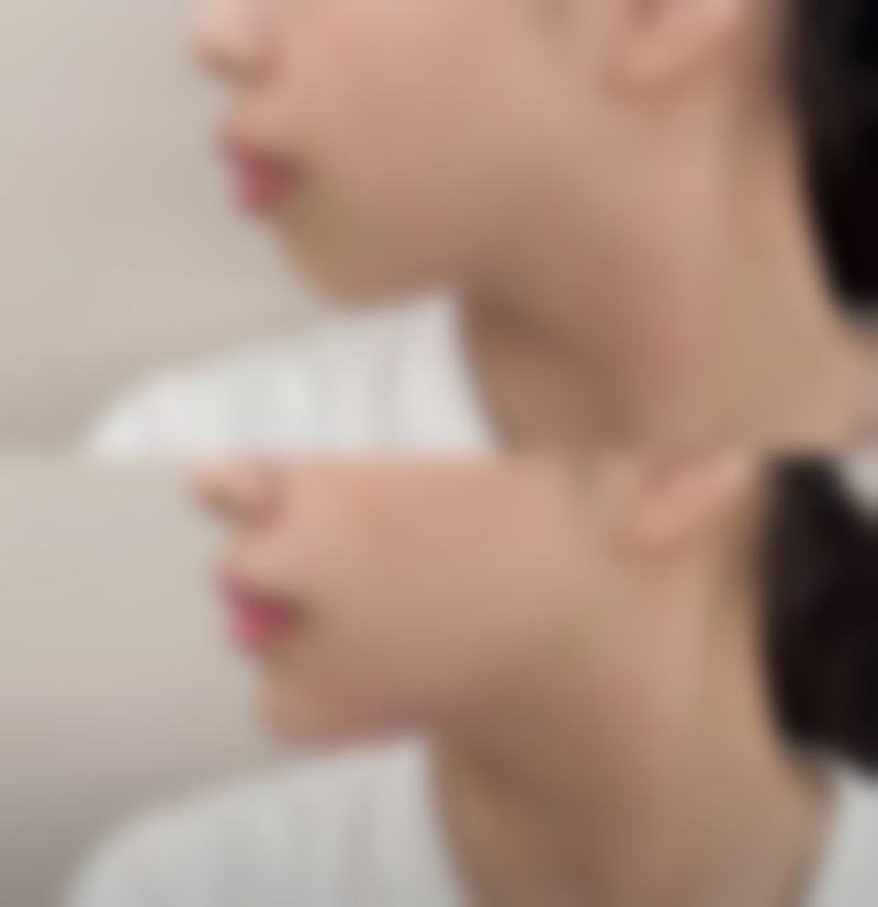 内双眼皮适合什么样的双眼皮贴——内双肿泡眼的黄金组合