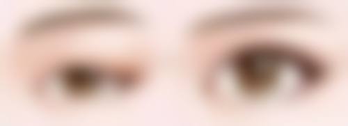 假体隆胸水滴和圆形术后成效区别：即刻美 VS 持久美