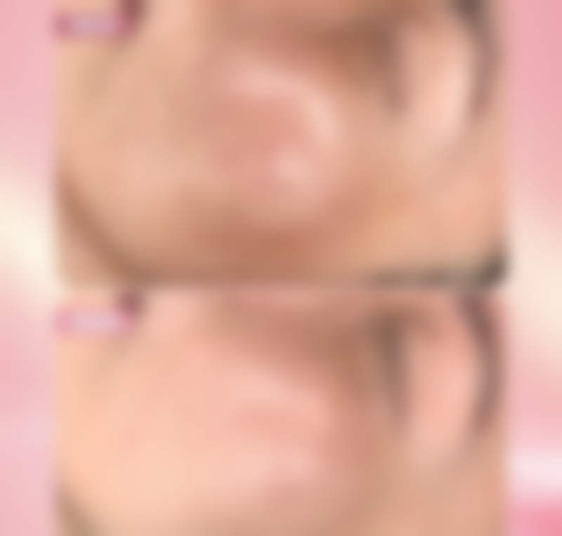 色素疤痕怎样祛掉：常见问题解答