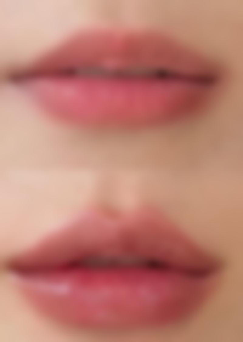 眼袋手术两侧不对称能修复吗:自然修复的概率