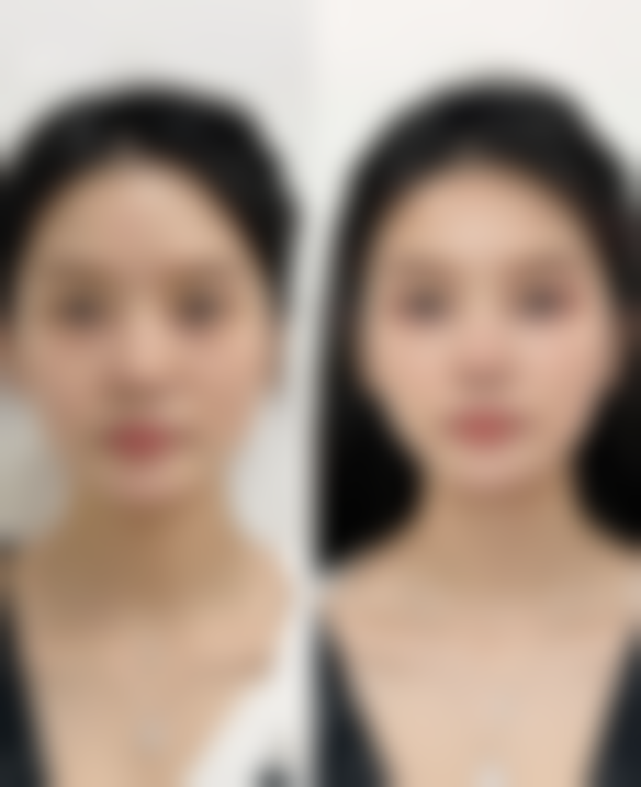 眼袋手术两侧不对称能修复吗:修复方法有哪些?