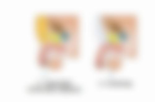 山东省立医院：自体软骨隆鼻1 - 3个月的稳定期