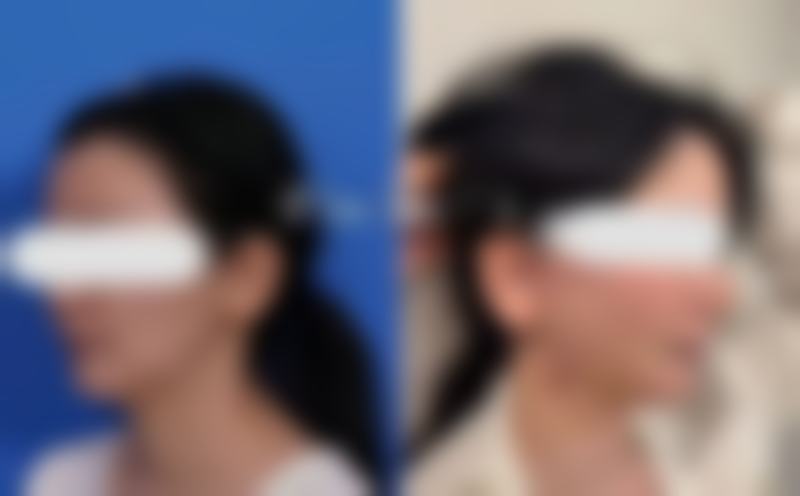 肚子吸脂风险大吗之常见误区澄清