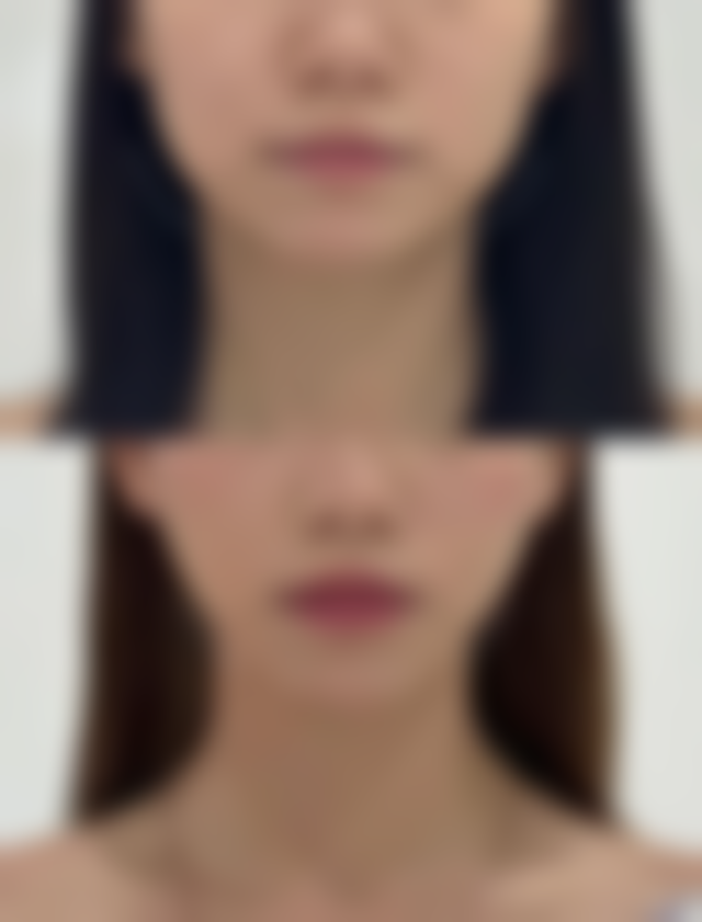 兰州五洲皮肤病医院强调熬夜后疤痕修复生活习惯调整