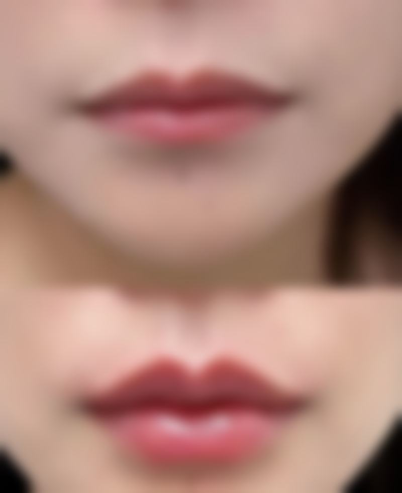 隆鼻后多久才能恢复到最佳形态，硅胶1-3个月/膨体3-6个月/线雕2-3周自然定型