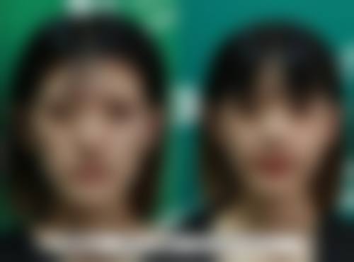 打了瘦脸针可以剧烈锻炼吗之风险大揭秘