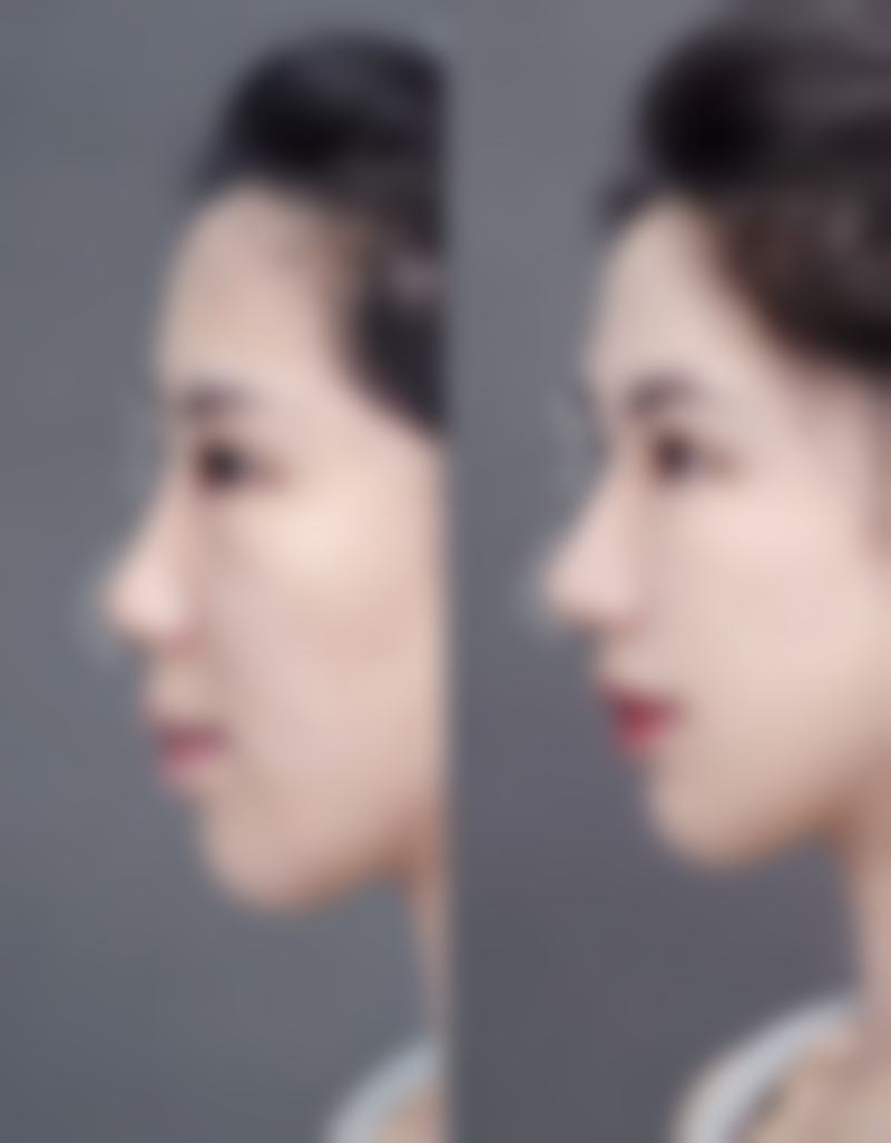 南通英莎医疗美容门诊部李辉手术风格——南通康美美容医院