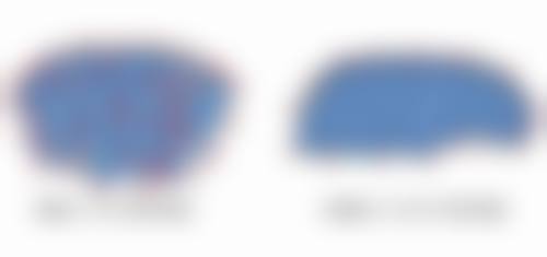 埋线双眼皮能管多少年之三等甲医院与私立医院对比