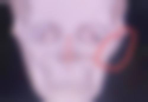 隆鼻线雕需要取出吗？3种情况必须取+最佳时间费用全解析