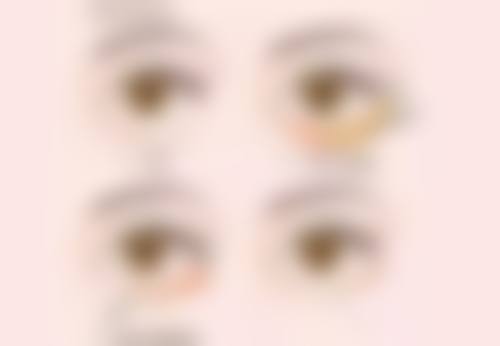 隆鼻线提升取出风险须知之全方面解读