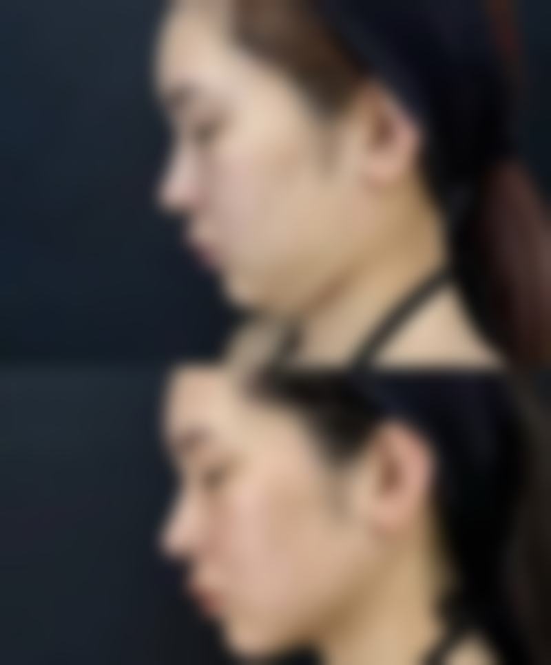 割过的双眼皮疤痕修复手术价格大揭秘