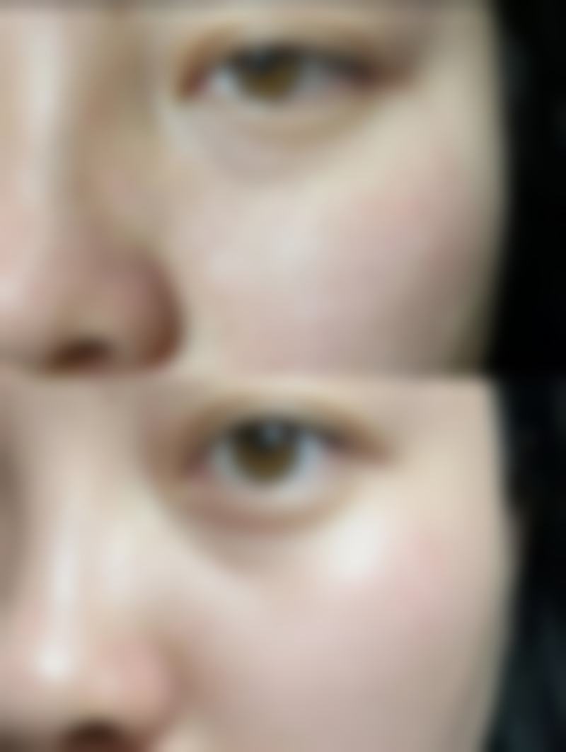 皮肤疤痕体质怎么治疗——药物治疗:国内医 大一院骨干医生强调内外兼修控制增生