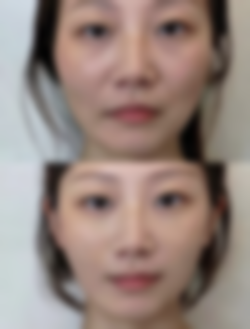 割过的双眼皮疤痕修复全攻略：不同阶段不同对策