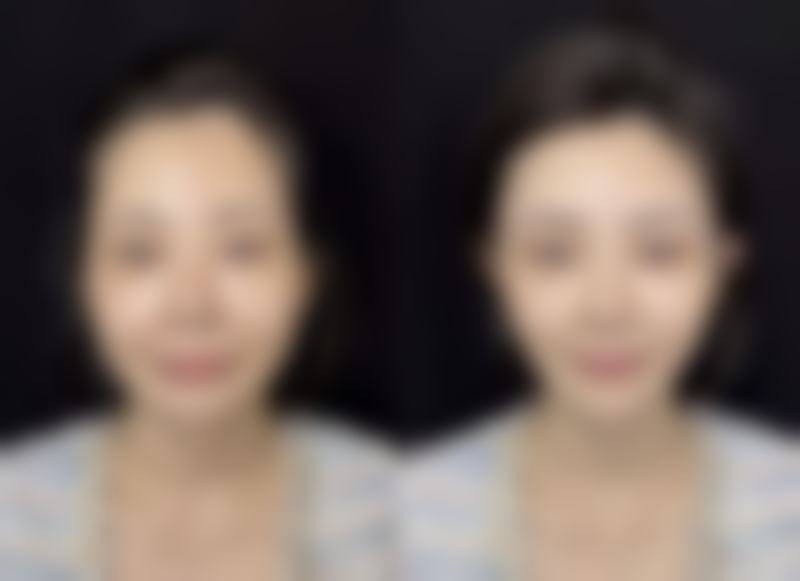 皮肤疤痕体质怎么治疗——日常护理:预防是关键,早护理成效好