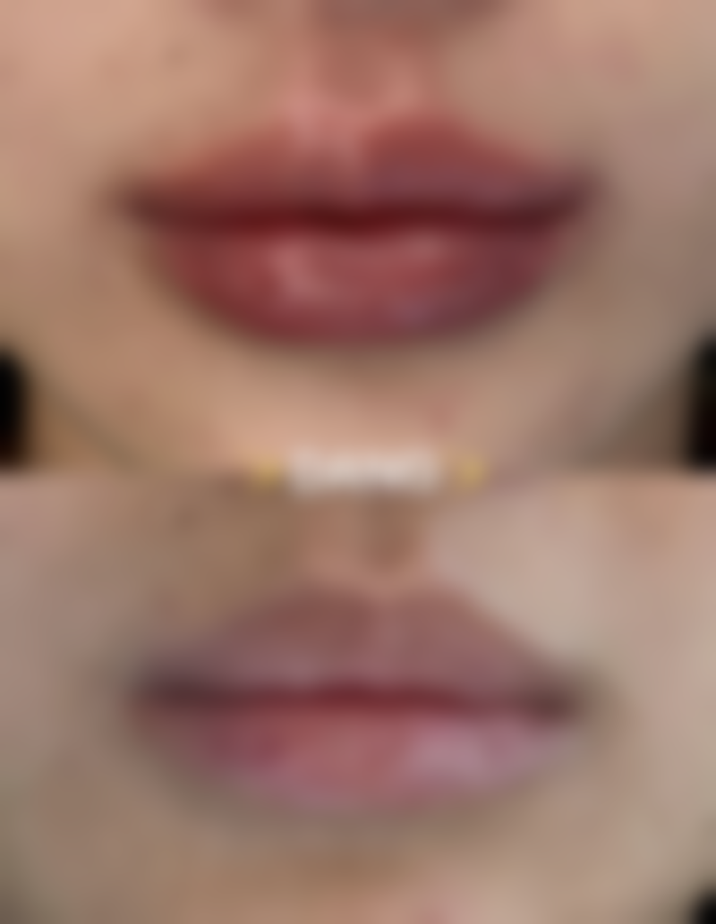 专精整形医院：割过的双眼皮疤痕修复的秘密武器