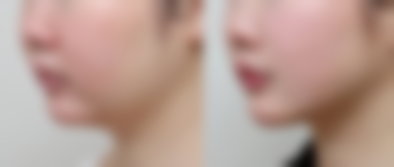 宝宝脸上的冻疮疤痕怎么去除——预防胜于治疗：5招让宝宝远离冻疮