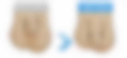 自体脂肪填充眼袋能保持多久？3-5年存活率关键，选对医生+护理翻倍持久