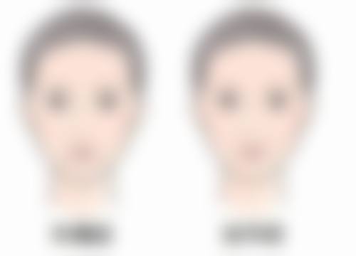 埋线方法怎么样可以变成双眼皮呢