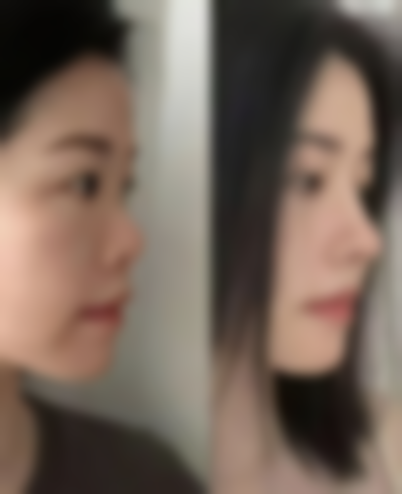 私立医院怎么样可以变成双眼皮呢