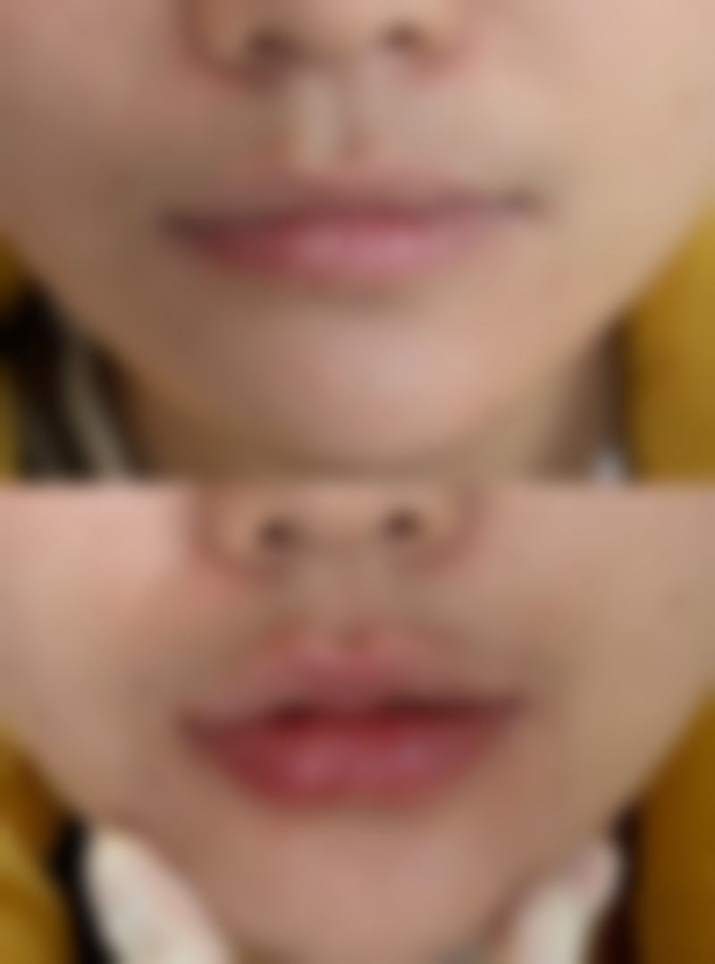 吸脂后其他时间节点的选择指南