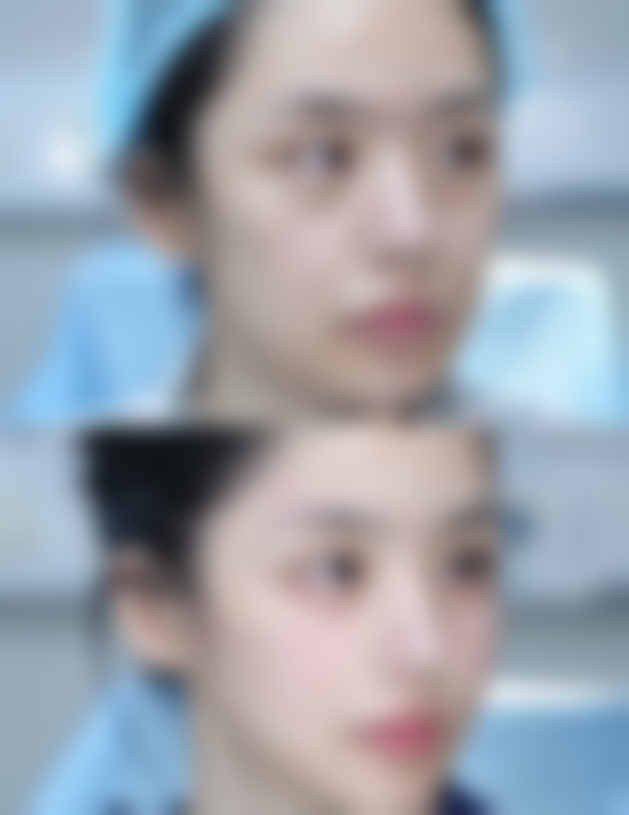 医生不会告诉你的5个“小秘密”——假体隆胸后取出的隐藏要点与疼痛关联