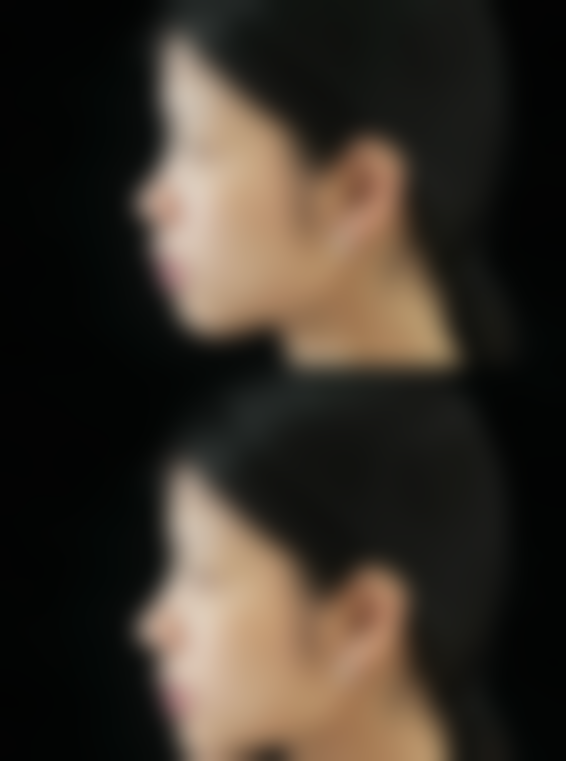 术后修复全攻略：这样做修复快一倍——假体隆胸后取出如何修复减少疼痛？