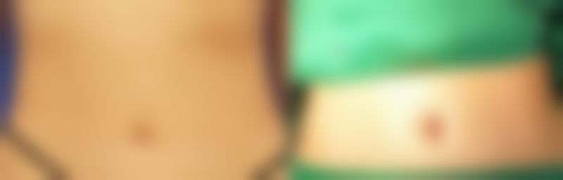 做双眼皮多久可以健身——术后分阶段运动建议