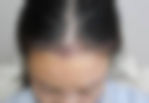 南京领秀植发医院真实患者口碑评价