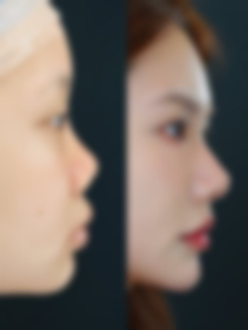 怎么按摩消除眼袋:成效评估,心中有底