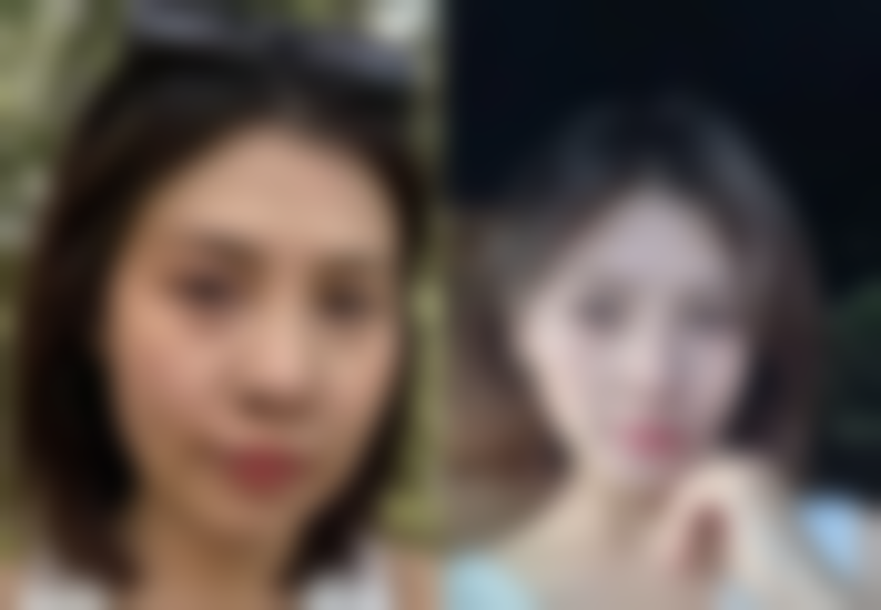 我的激光 + 药物祛疤实测经历