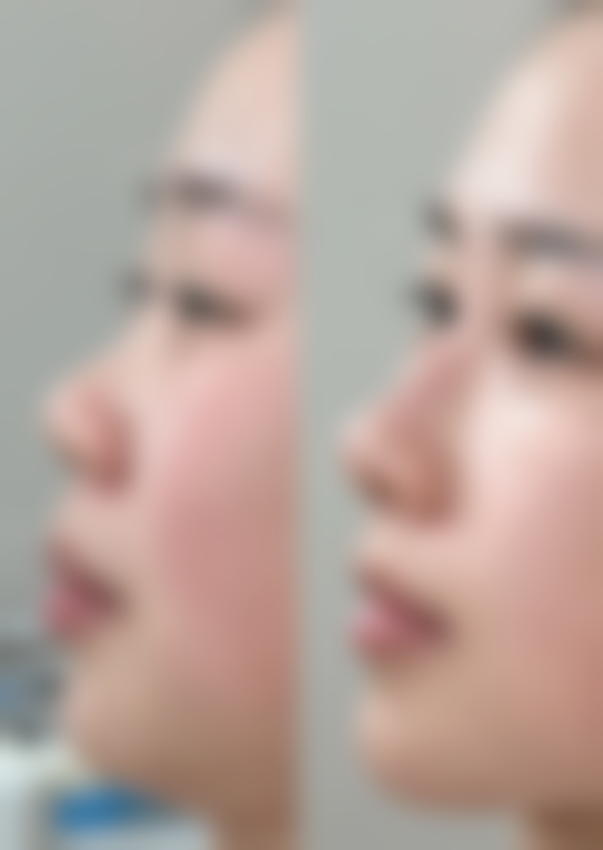 怎么按摩消除眼袋:把握黄金频率,快速见效