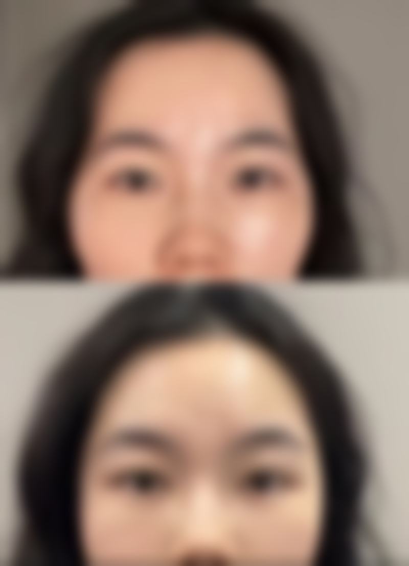 全切双眼皮多久红色线能消失？3个月消退周期+加速恢复小妙招