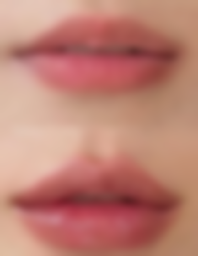 种植发际线1年能长起来吗：更终成效与稳定标志