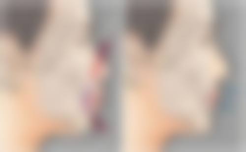 刘学源医生做手术价格情况