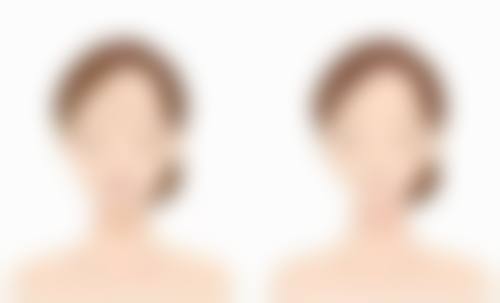 硅胶假体隆胸早期乱捏的三大危害