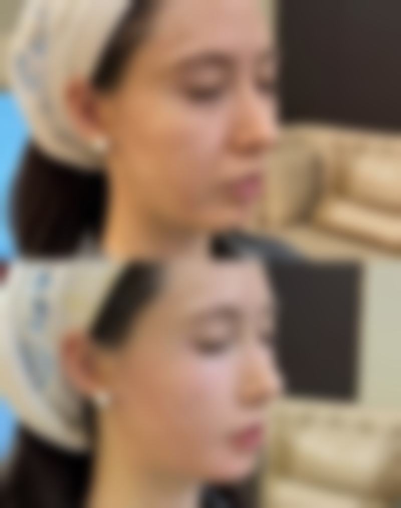 抽脂后腹部多久能不疼：和“隐形束腰”说拜拜