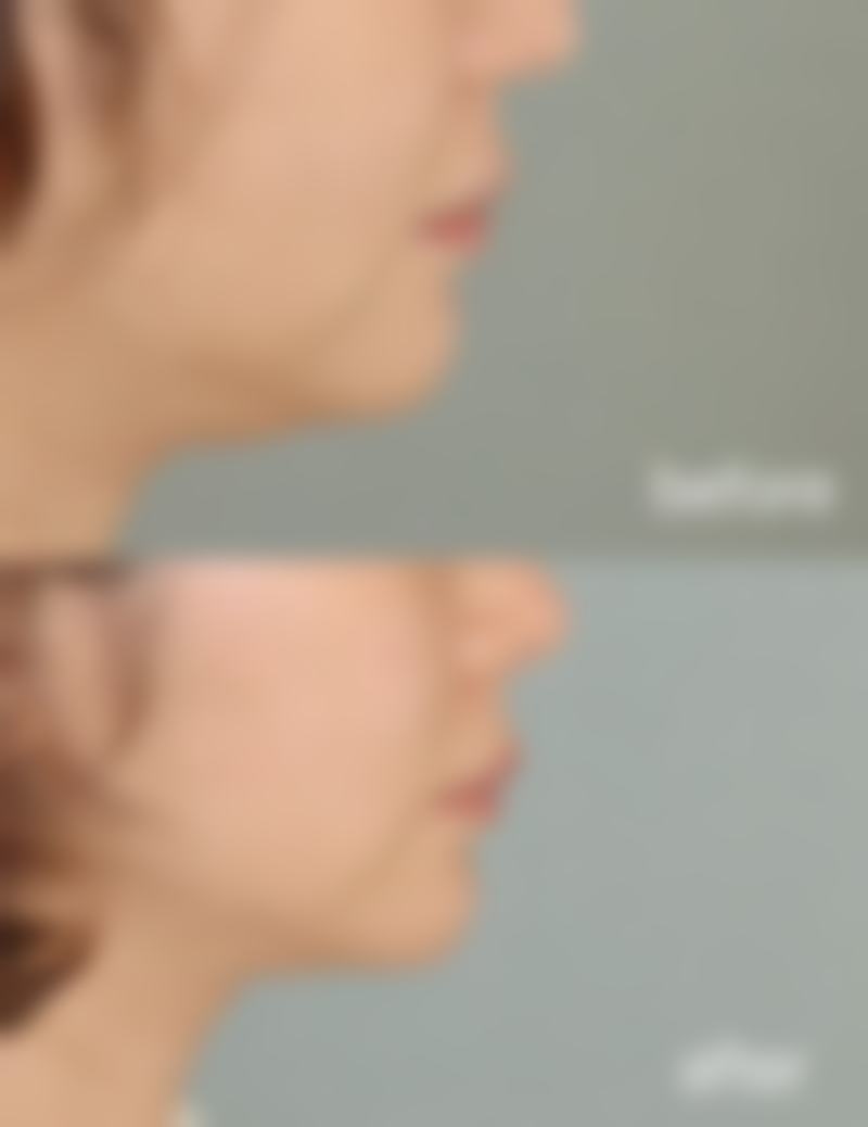 硅胶假体隆胸正确按摩手法大公开