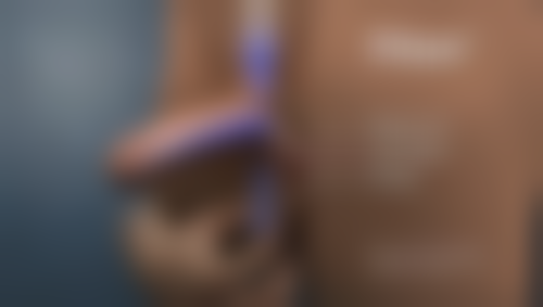 徐启娟医生做手术价格