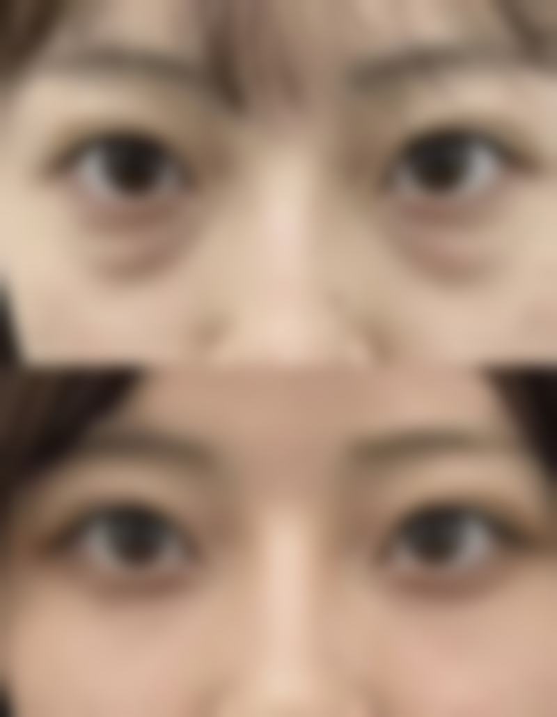 隆胸修复期是多长时间：影响修复的关键因素大揭秘