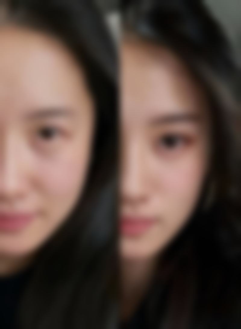 怎么把肿眼泡眼睛睡成双眼皮：消肿是关键突破口