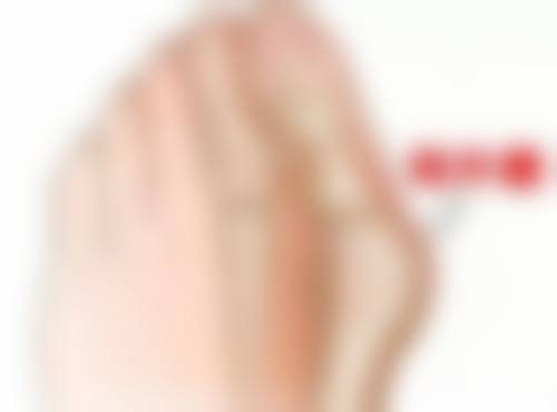 夏天能做双眼皮吗之修复成效探究