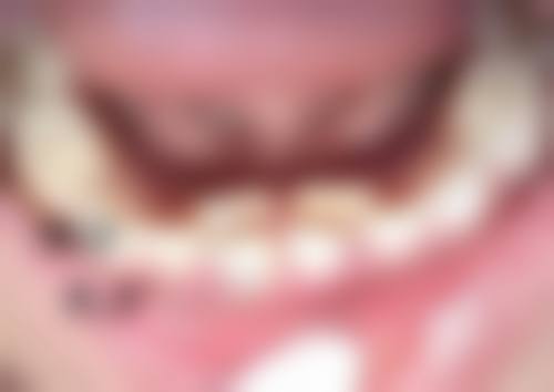 割双眼皮会遗传给下一代吗？揭秘手术原理与遗传概率，男女差异大公开