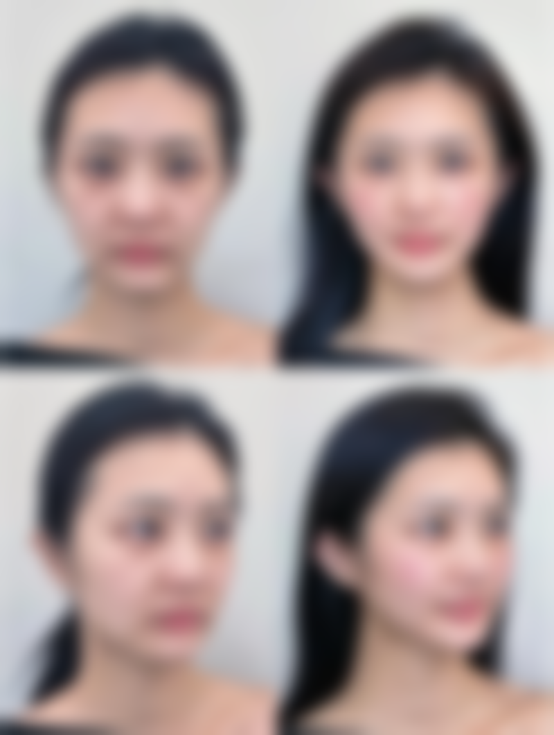 割双眼皮会遗传给下一代吗——男女遗传差异的真相