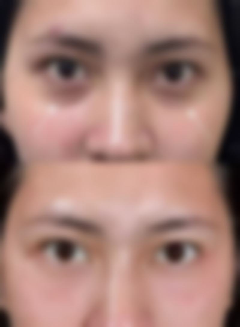 肚子抽脂心理调适时间与保健小锦囊