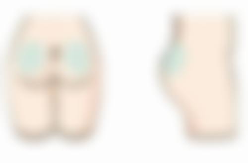 后天眼袋怎么去除——医美途径，高新科技“灭袋”武器库